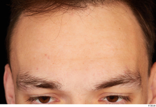 Alessandro Katz forehead head 0001.jpg